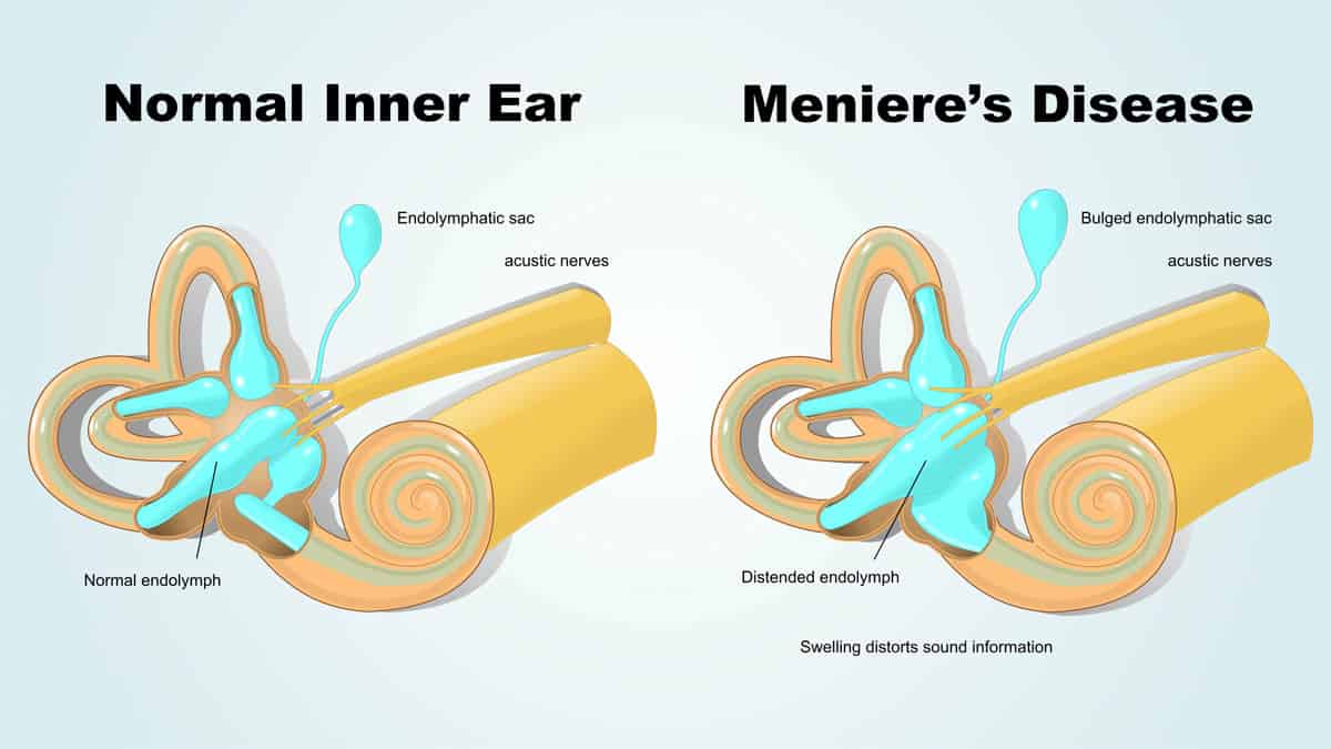 Menieres Diagram