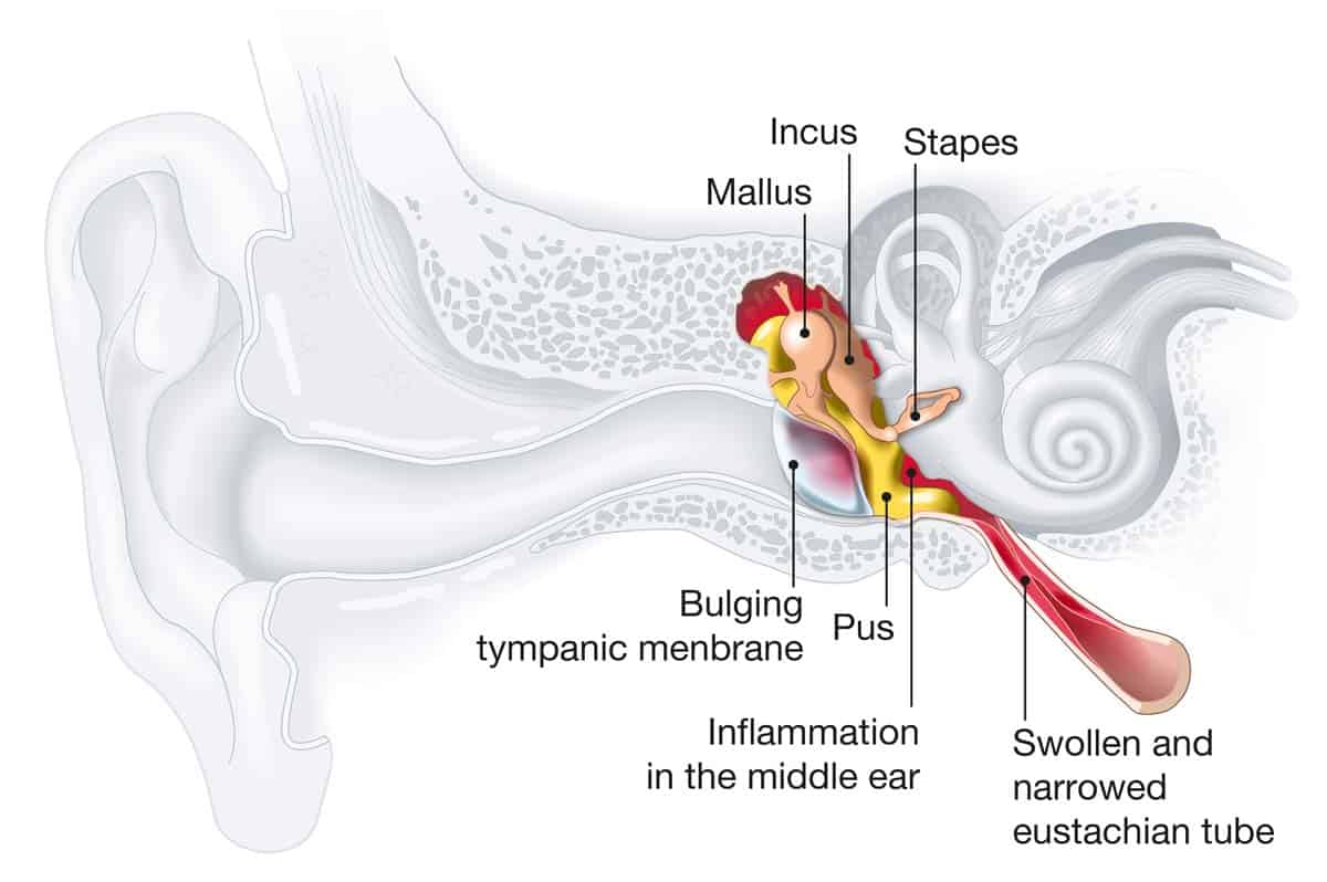 Middle Ear Infection