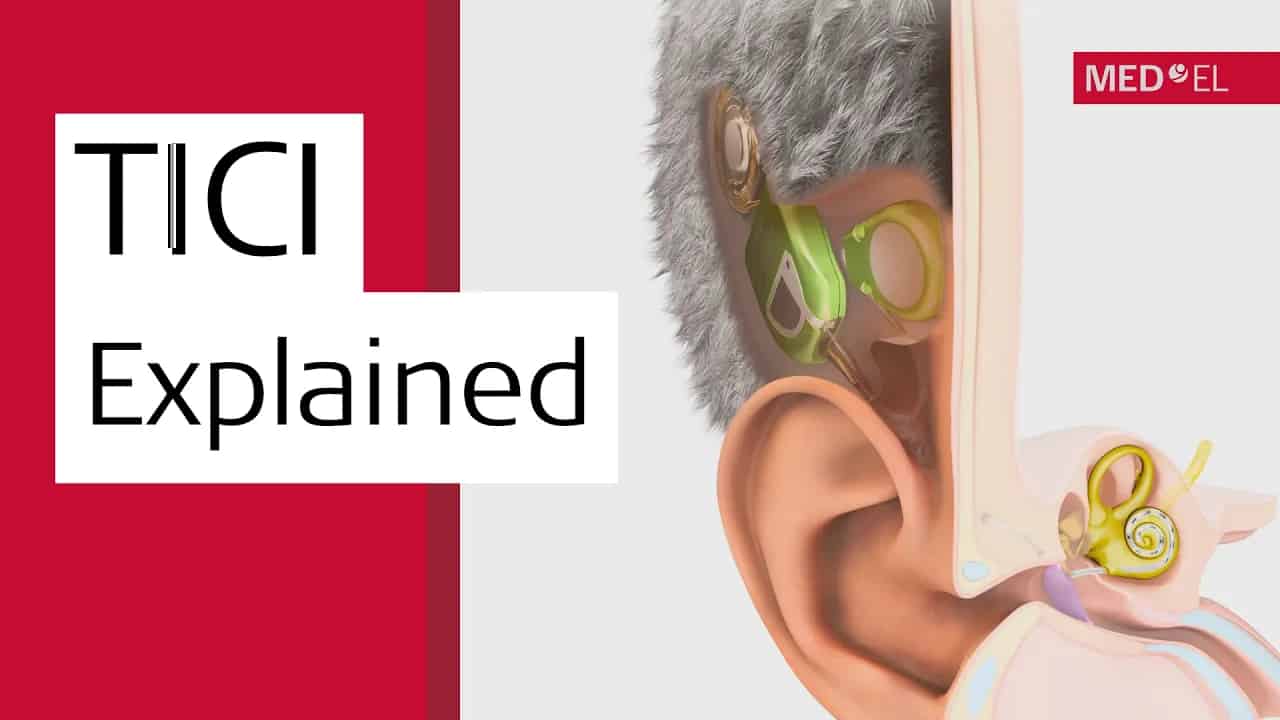 How Invisible Cochlear Implants Work | MED-EL TICI UNICO