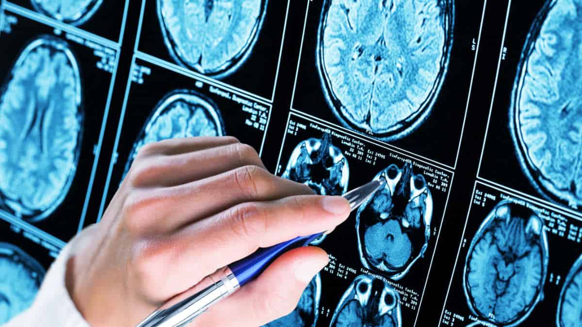 Brain Imaging Dementia