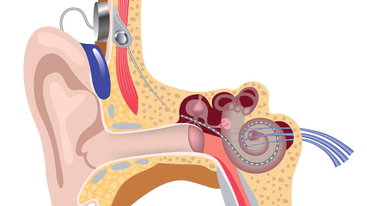 Cochlear Implant Diagram