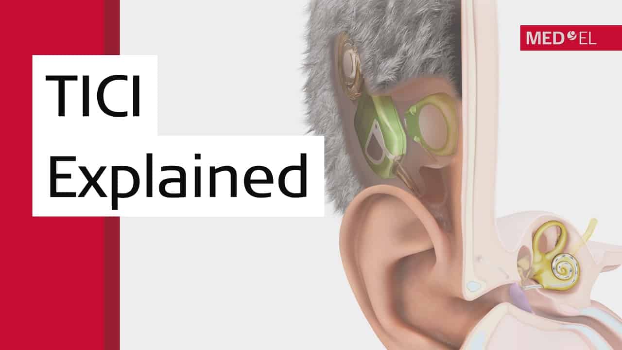 How Invisible Cochlear Implants Work | MED-EL TICI UNICO How Invisible Cochlear Implants Work | MED-EL TICI UNICO
